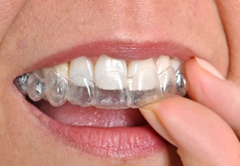 θεραπεία δυσλειτουργίας κροταφογναθικής διάρθρωσης,νάρθηκες σύγκελισης,νάρθηκας θεραπείας δυσλειτουργίας κροταφογναθικής διάρθρωσης,νάρθηκες θεραπείας βρυγμού 